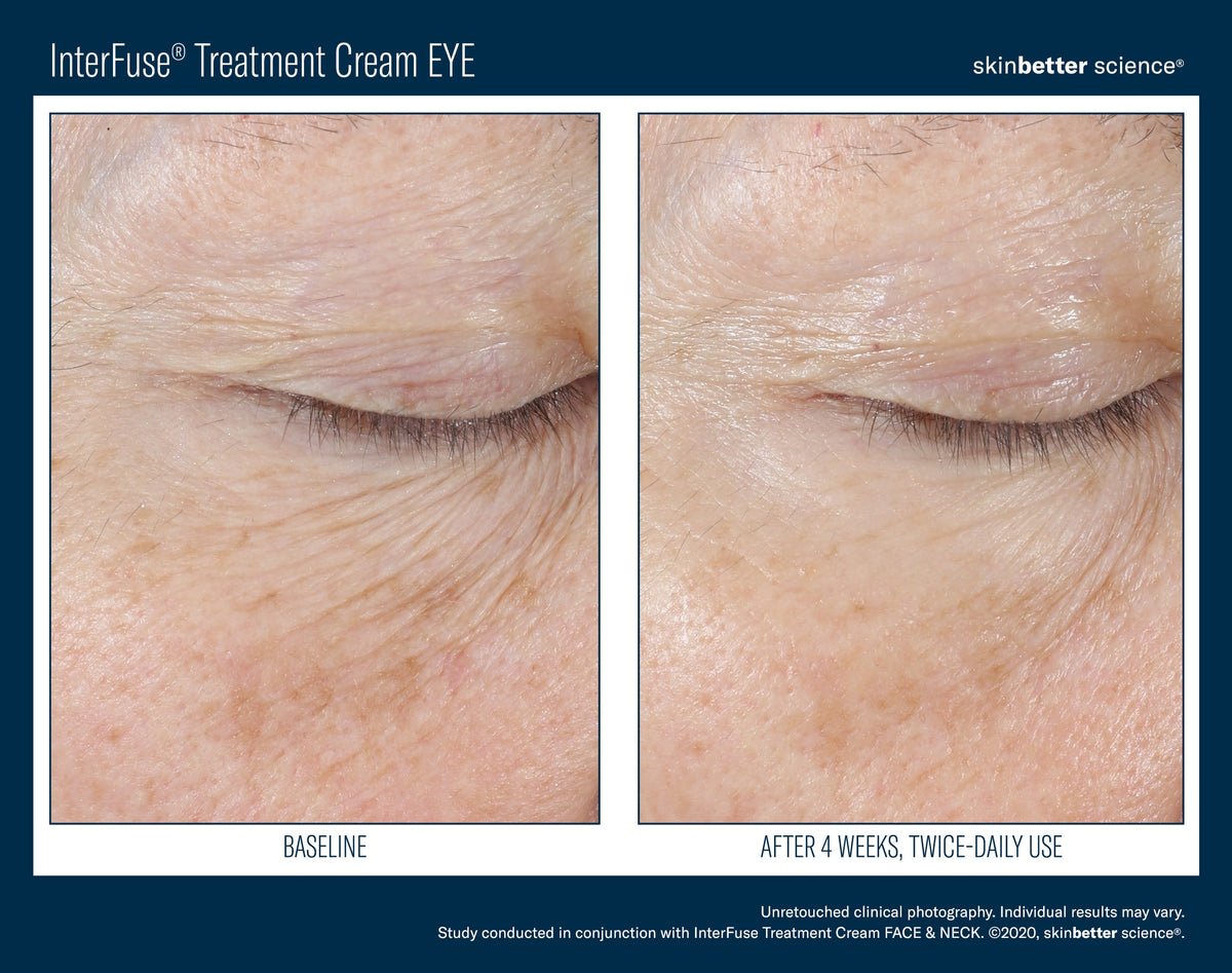 InterFuse Treatment Cream EYE 15 ml