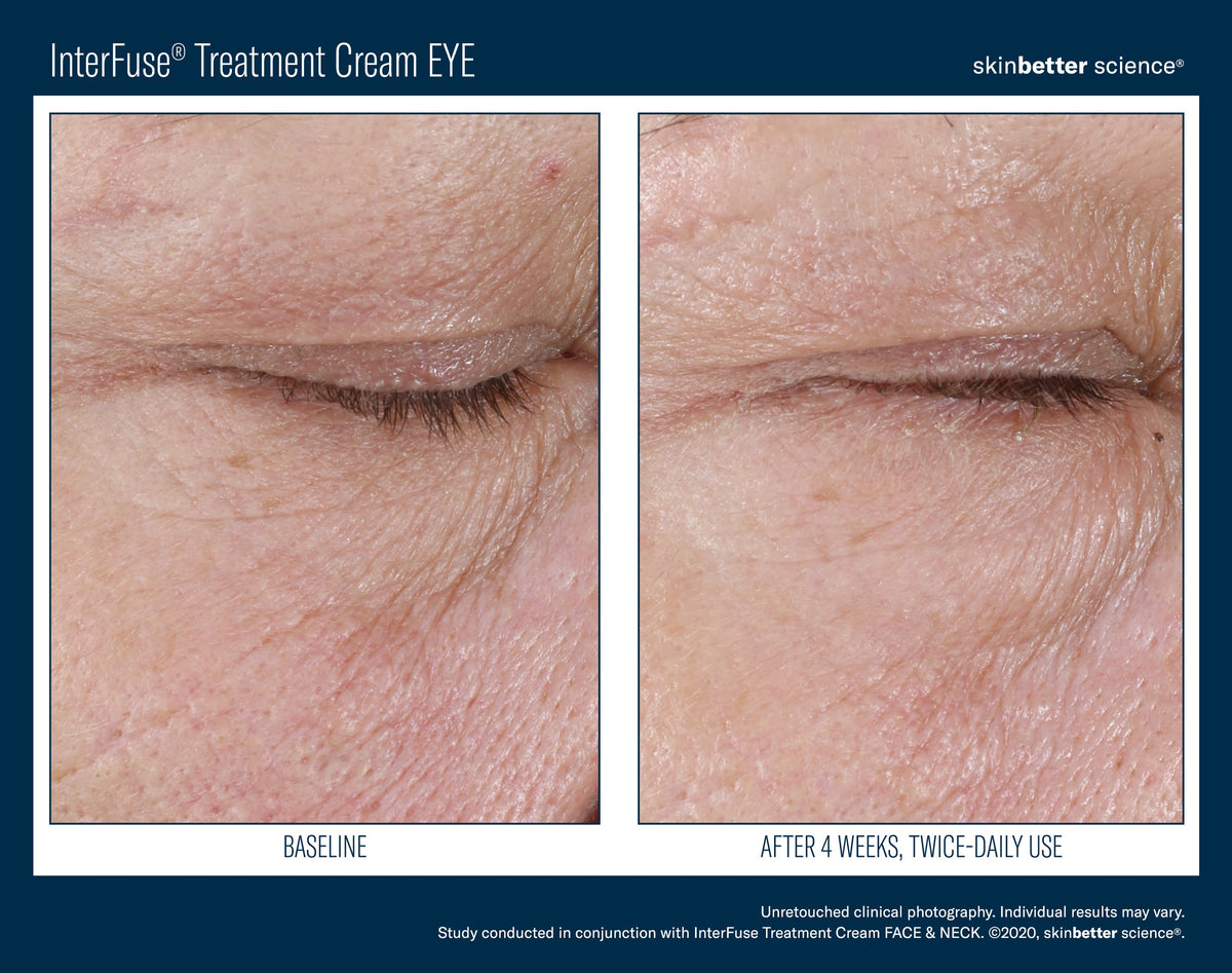 InterFuse Treatment Cream EYE 15 ml