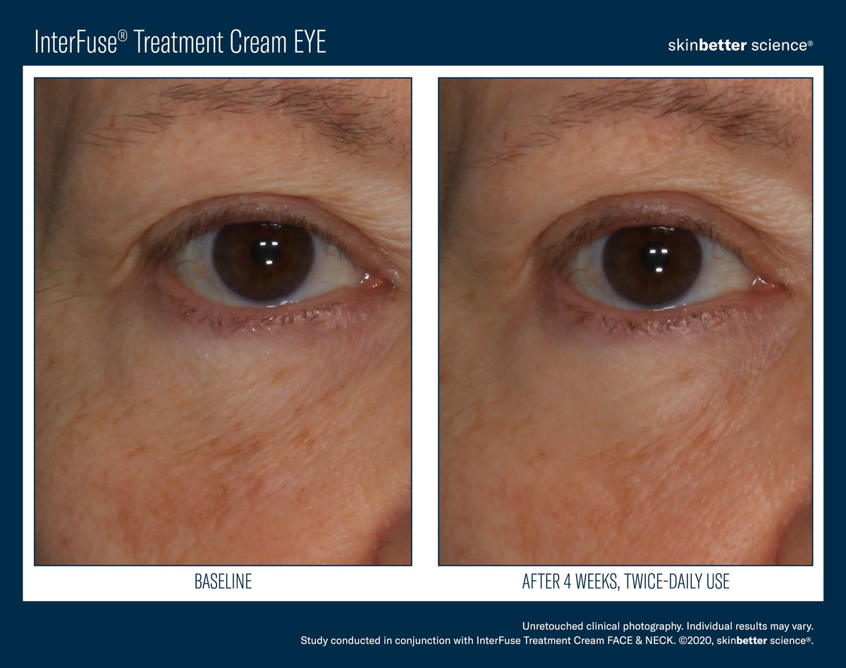 InterFuse Treatment Cream EYE 15 ml
