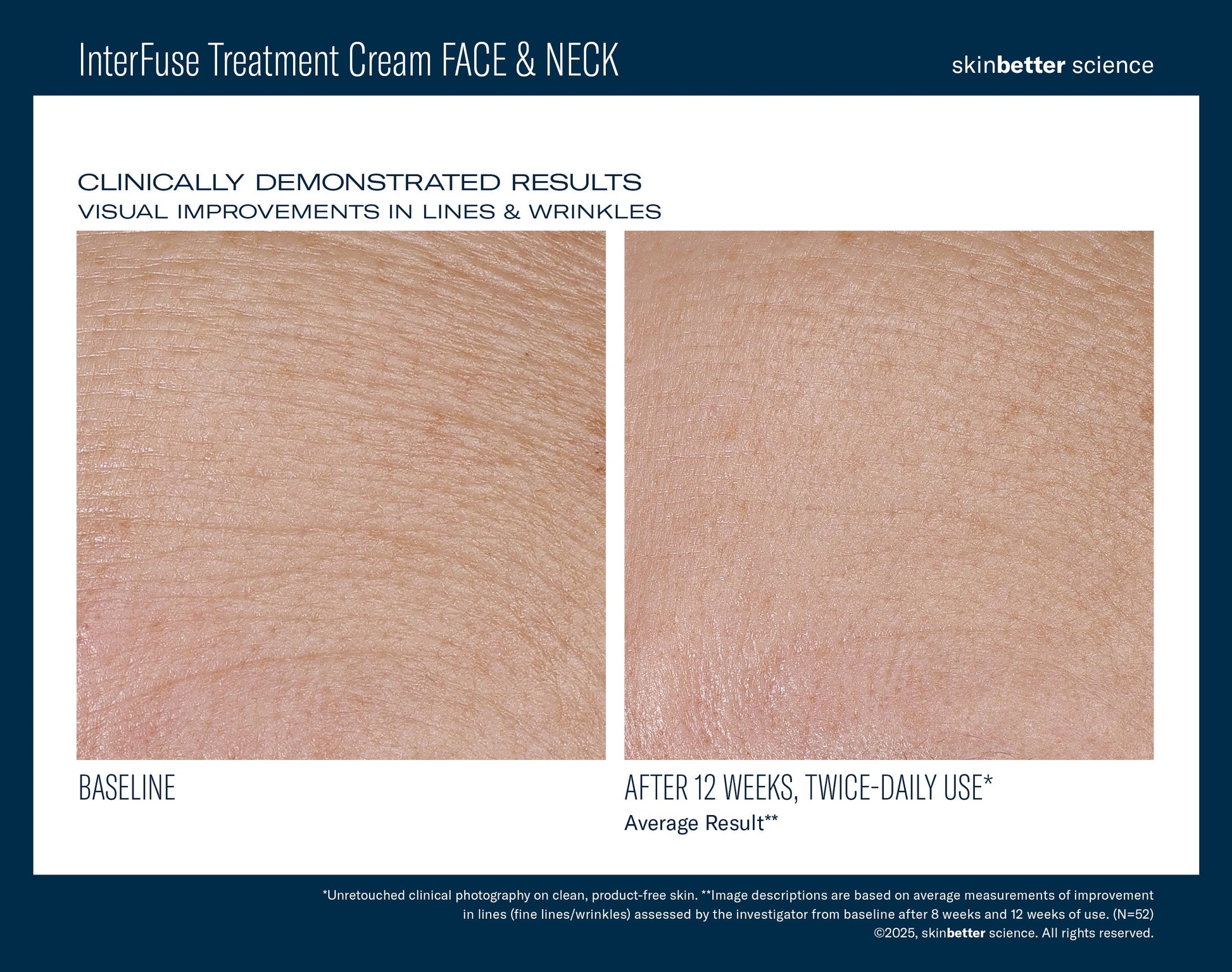 InterFuse Treatment Cream FACE & NECK 30 ml