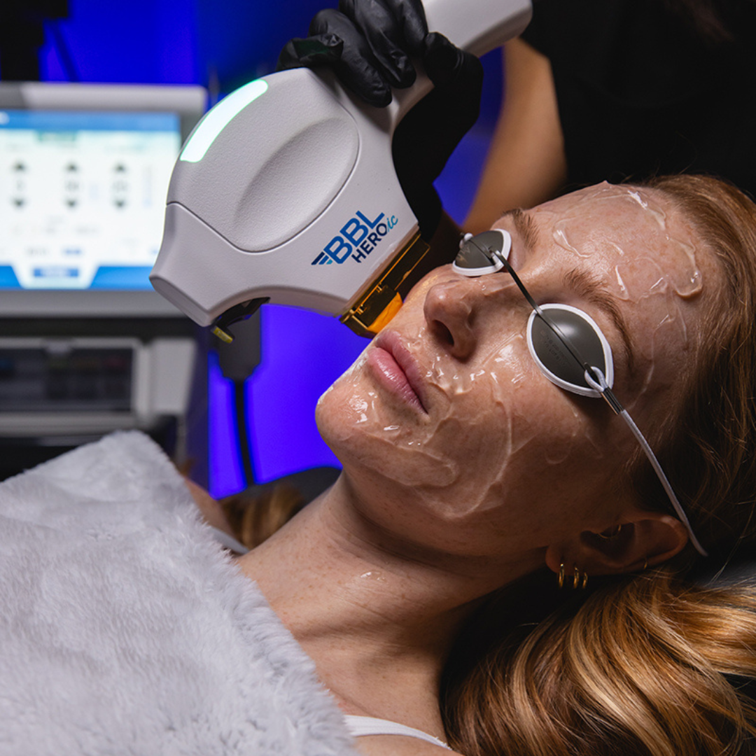 Buy 3 BBL Face Treatments — Get Hands, Neck, or Chest FREE! Plus, a post-care treatment kit.
