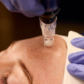 Purchase a package of 3 SkinPen Face Neck and 3 BBL Face Neck treatments — Save $1,000